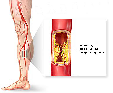 Как вылечить атеросклероз сосудов ног?: статьи клиники Оксфорд Медикал Киев