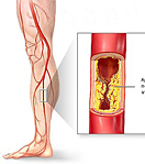 Симптомы и лечение облитерирующего атеросклероза сосудов нижних конечностей