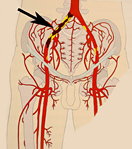 Атеросклероз нижних конечностей лечение москва