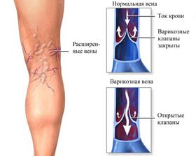 Варикоз вен на ногах: причины, симптомы и лечение