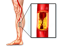 Атеросклероз сосудов ног: симптомы и лечение